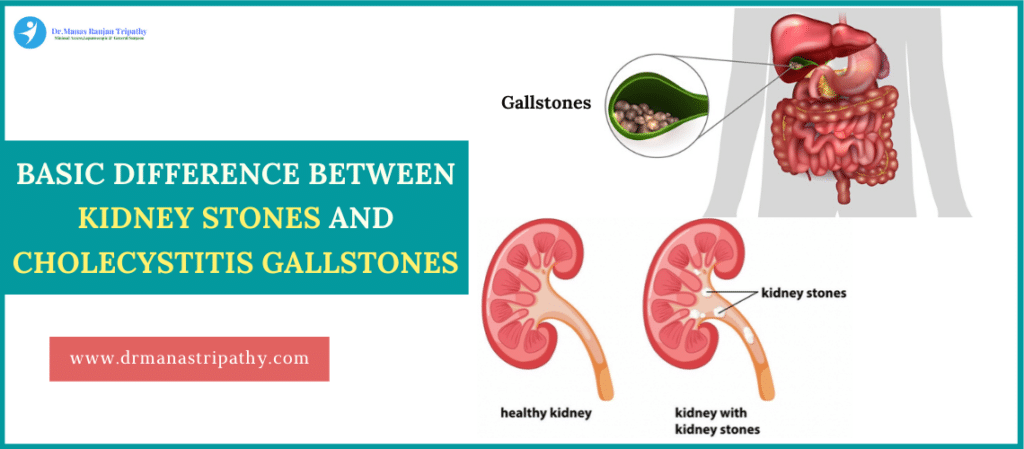 Basic difference between Kidney Stones and Cholecystitis Gallstones