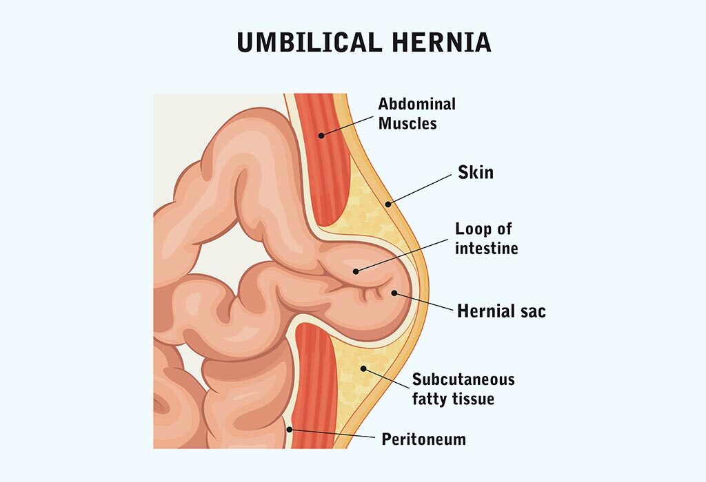 umbilical hernia