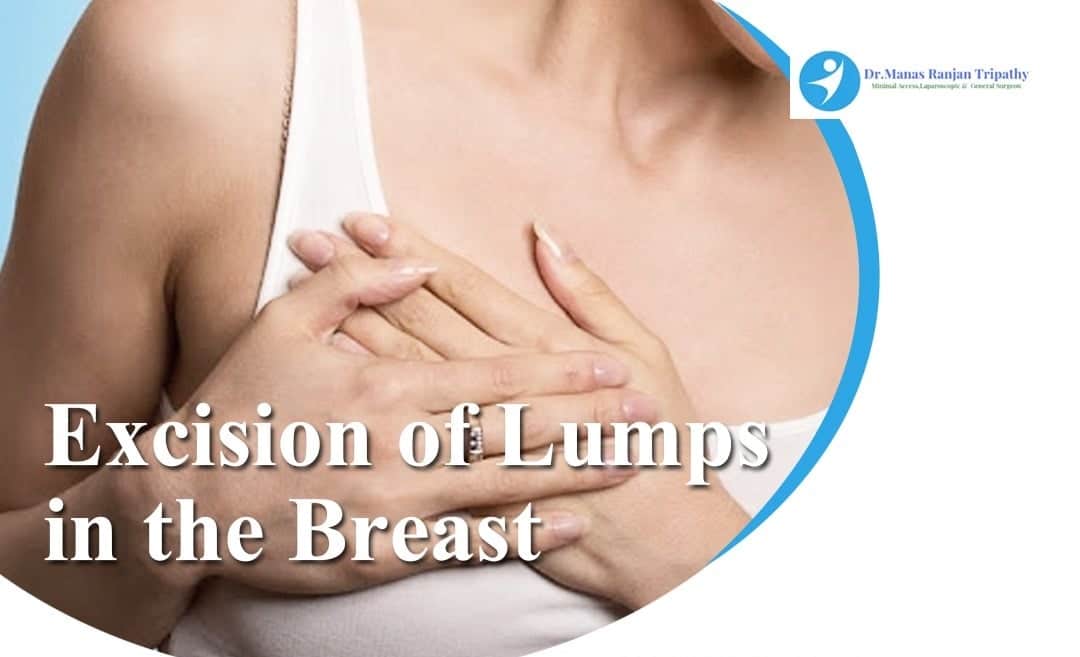 Excision of Lumps in the Breast