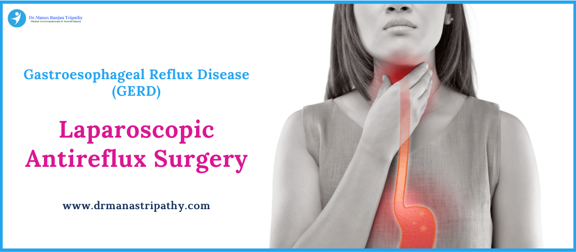 Laparoscopic Antireflux Surgery in Bangalore